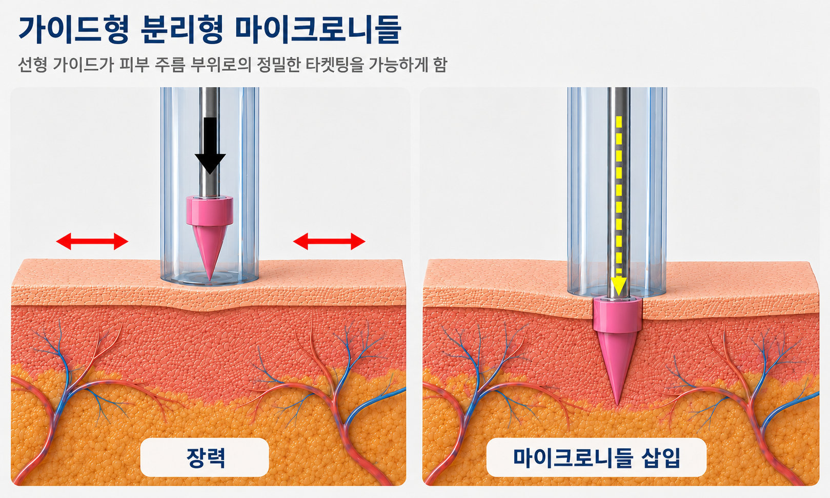 가이드형, 균일한 삽입