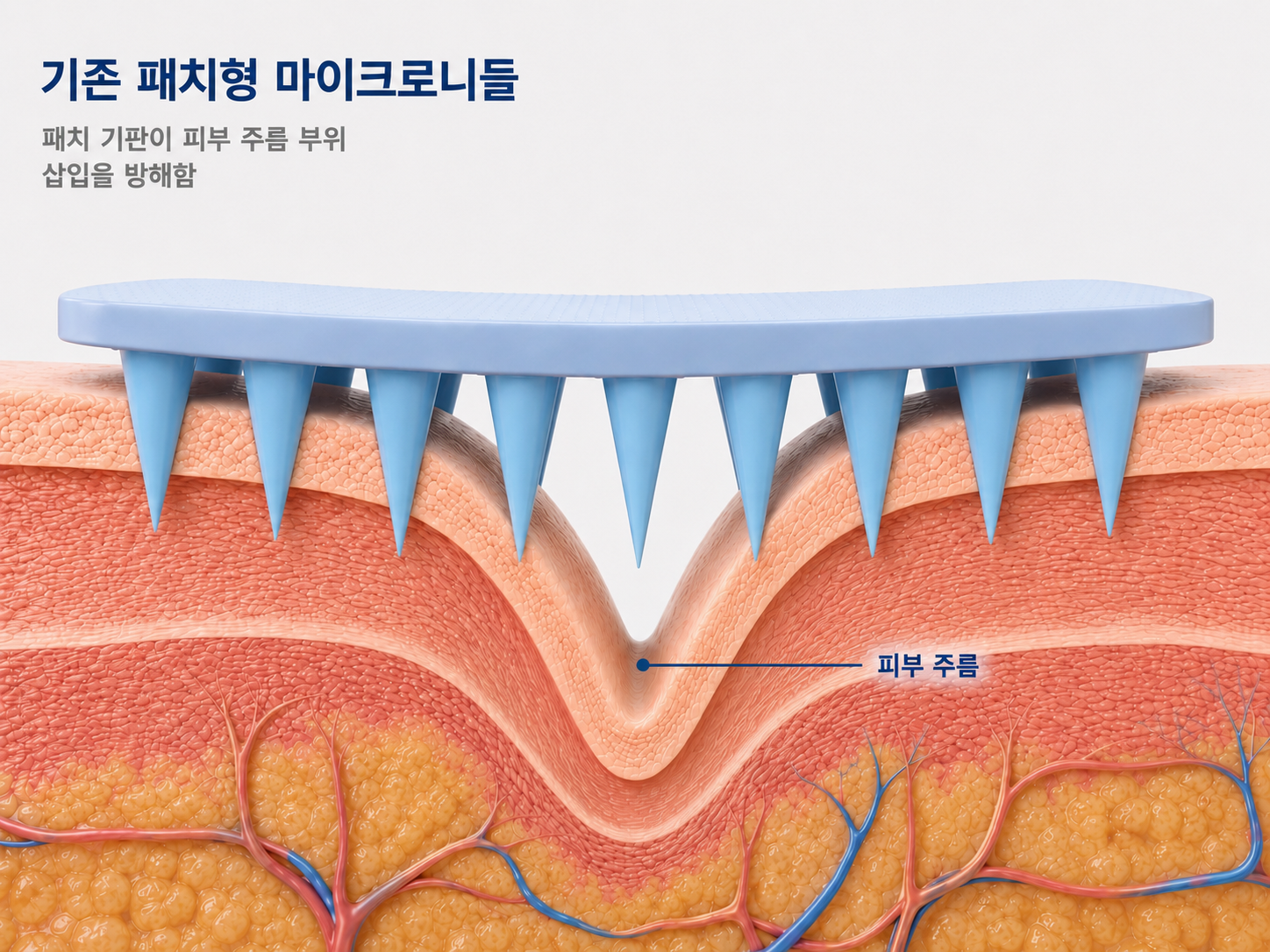 기존 패치형