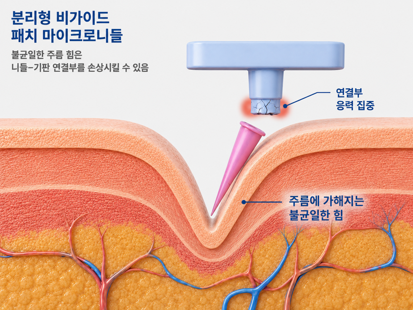 분리형, 가이드 없음